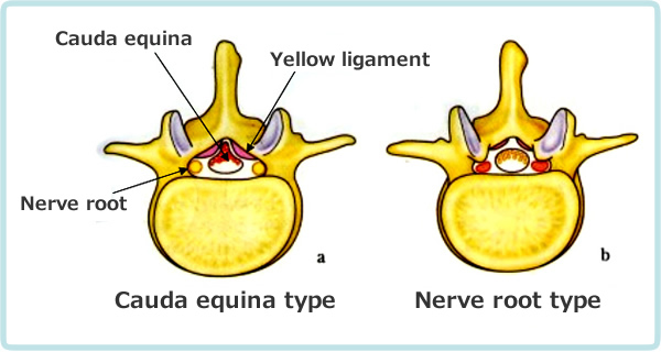 Schematic diagram of spinal canal stenosis: cauda equina type and nerve root type.<br>Adapted from Kikuchi: Journal of the Japan Orthopedic Association, 62: 571, 1988.