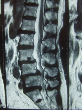Anterior slip at L3 and L4, posterior slip at L5, and spinal canal stenosis at L3/4, L4/5, and L5/S1.
