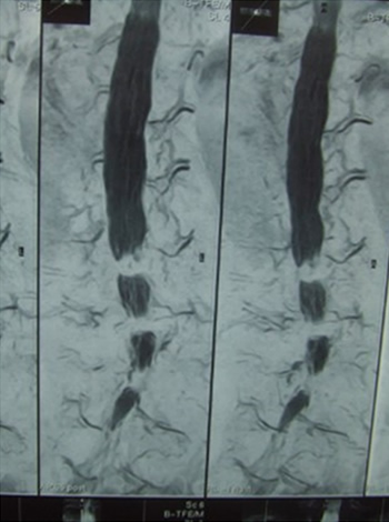 Stenosis of L3/4, L4/5, and L5/S1
