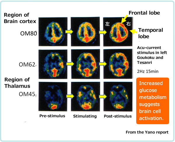 Acupuncture current stimulation at the Goukoku-Tesanriincreases glucose metabolism in the brain.