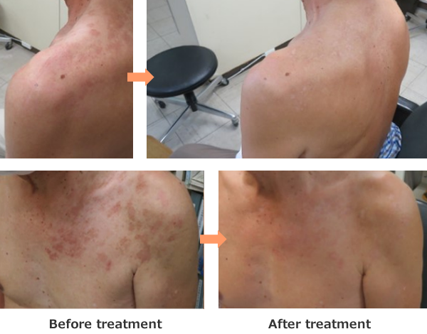 Comparison of shingles skin rash on the chest and shoulders before and after new meridian therapy. The skin rash has disappeared with treatment.