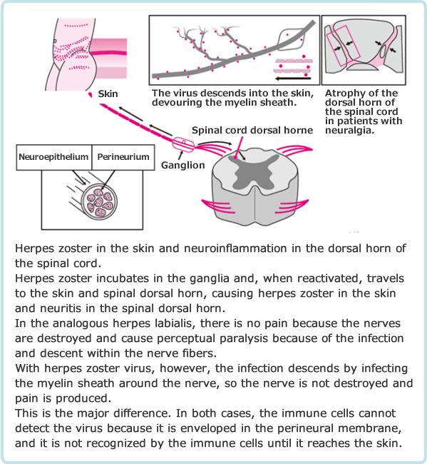 Mechanism of herpes zoster cutis and neuritis of the dorsal horn of the spinal cord.