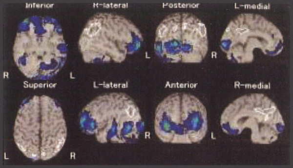 Blue areas indicate decreased blood flow. Blood flow reduction is seen mainly in the frontal lobe.