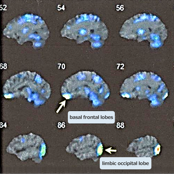 3D-SSP shows hypoperfusion in the bilateral basal frontal lobes and the left limbic occipital lobe (arrows). 
