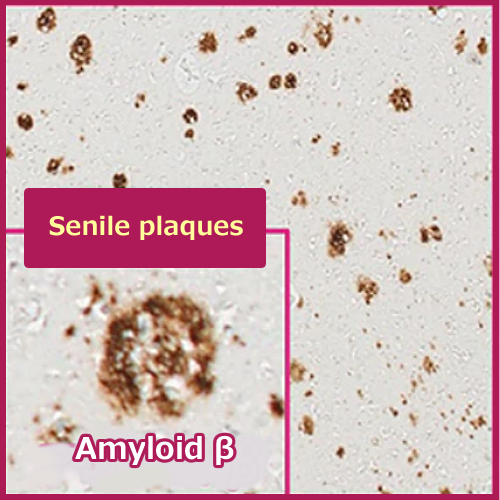 Amyloid β protein (NHK: from Haruo Hanyu)