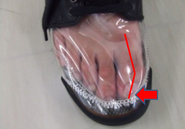 Eversion of the big toe when wearing transparent shoes